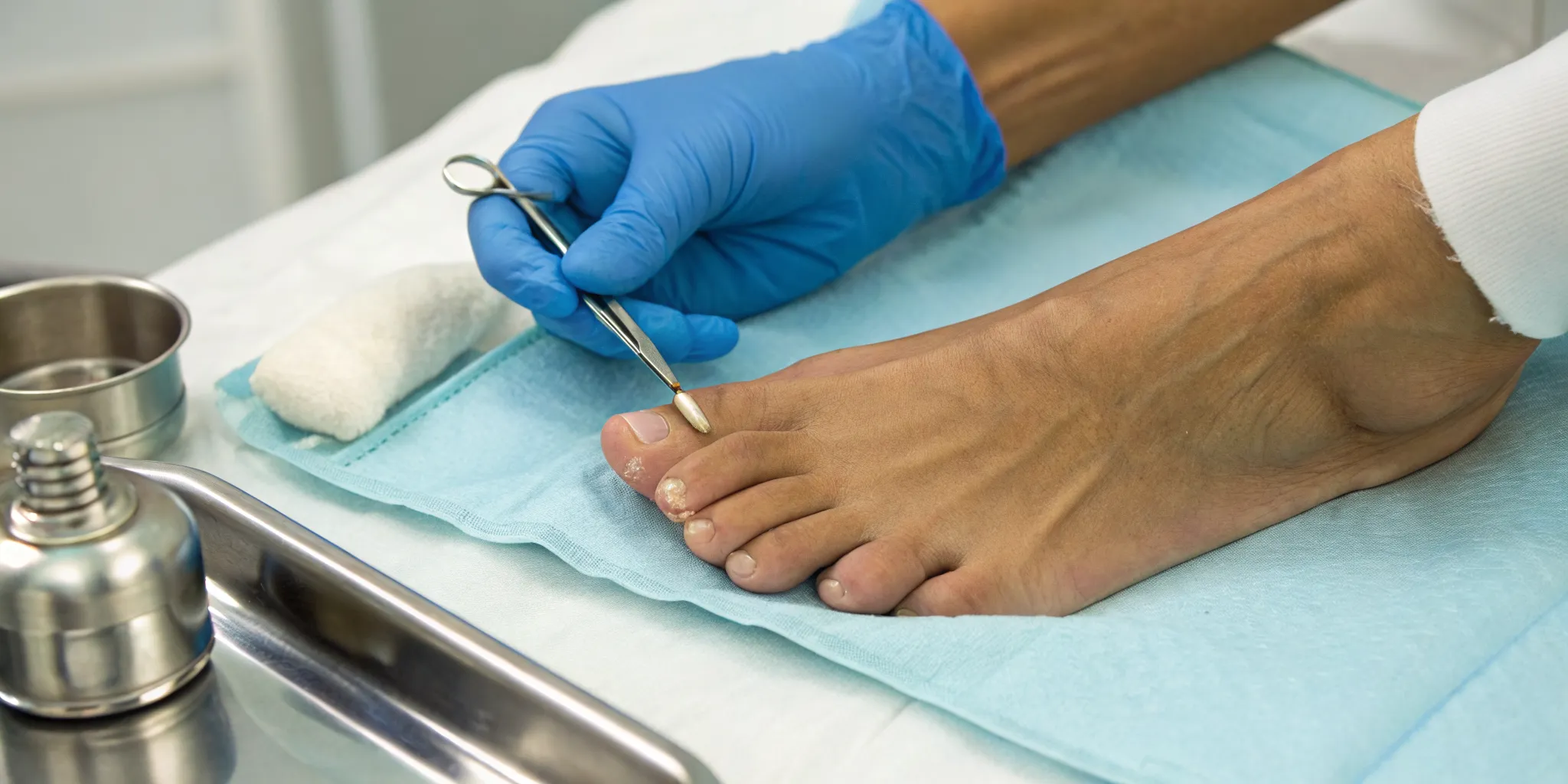 Permanent ingrown toenail removal surgery performed by a podiatrist on a toe.