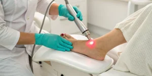 Close-up of a laser for plantar wart removal, a procedure affecting the final cost.