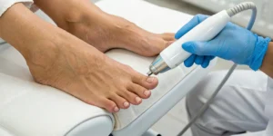 Laser therapy for hammertoe pain applied to a patient's foot.